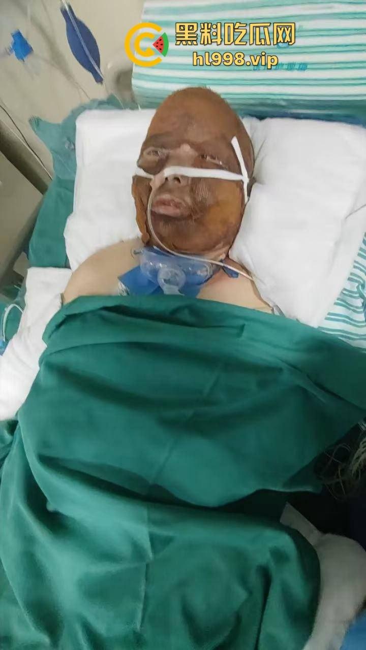 伟大的母亲!浙江诸暨市家中厨房煤气爆炸妻子惨遭烧伤之痛-5