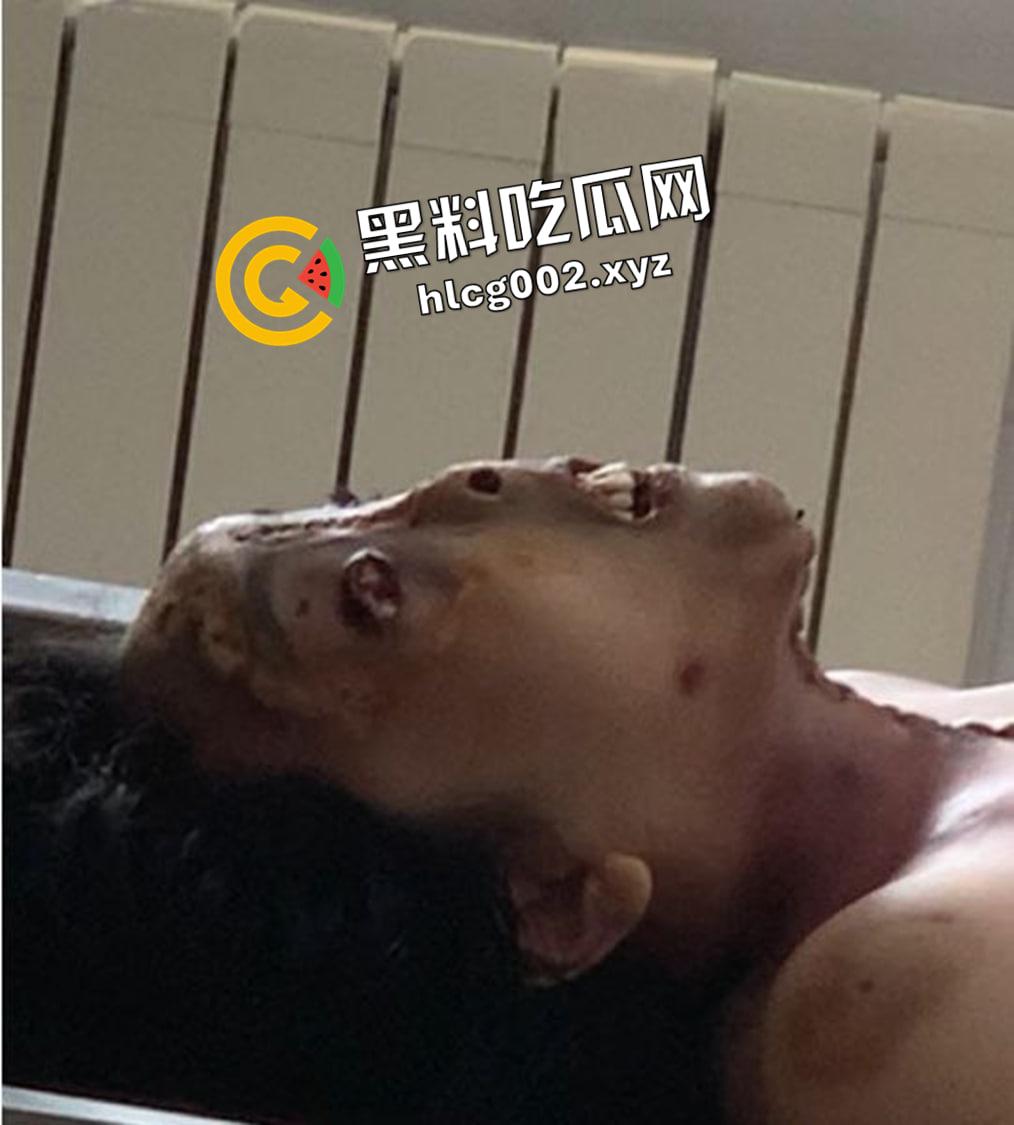恐怖慎入！辽宁【徐园】案尸检现场视频流出 被前男友家暴致死打的面目全非-5