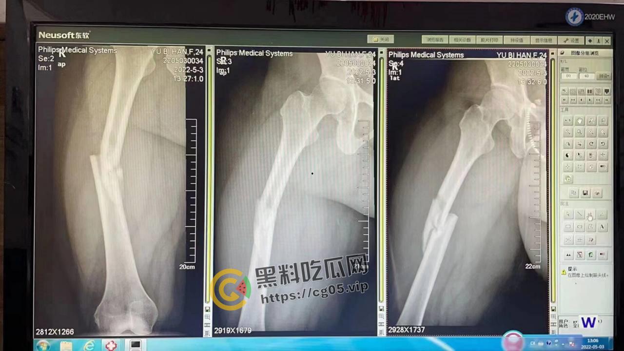 坦克坠楼!三百斤猪猪女孩12楼跳下 车都砸坏了人没死 事后检查仅骨折-8